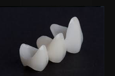 Ceramic Crown Bridge