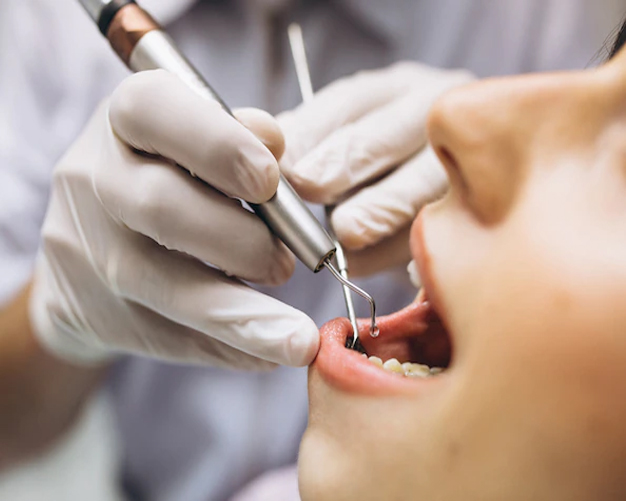 full dental implants in hyderabad