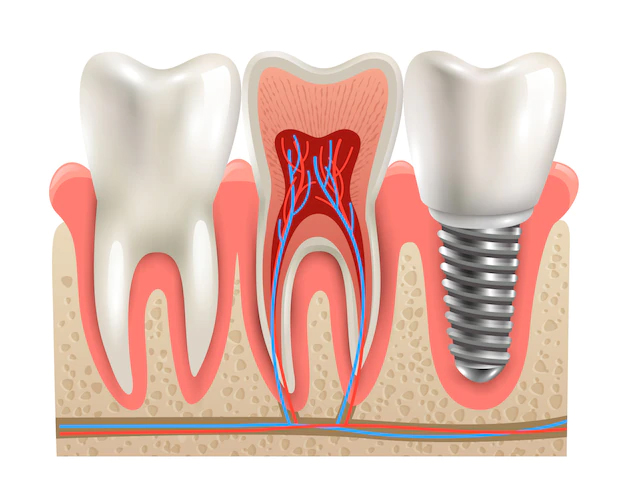 Illustration showing a natural tooth, a tooth with exposed roots and nerves, and a dental implant fixed into the jawbone