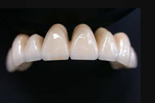Full Ceramic Crown Set