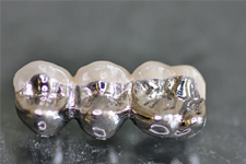 Metal Dental Bridge