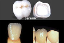 Dental Articulator