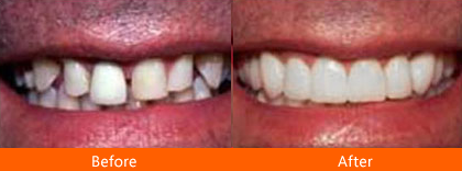 Before and after dental treatment showing improved teeth alignment and a brighter smile