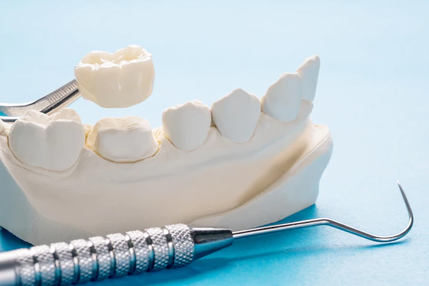 Dental crown being placed on a tooth model with dental instruments on a blue background