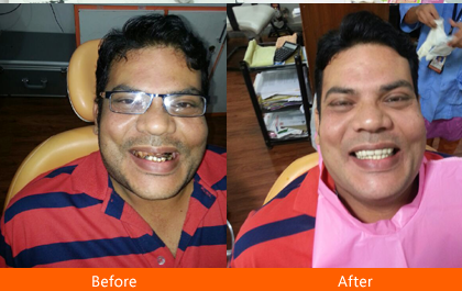 Before and after dental treatment showing a patient’s improved smile and restored teeth
