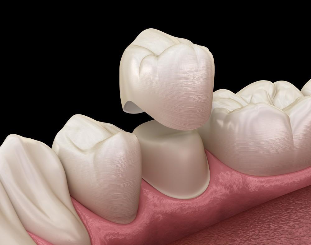 Ceramic crowns smile makeover