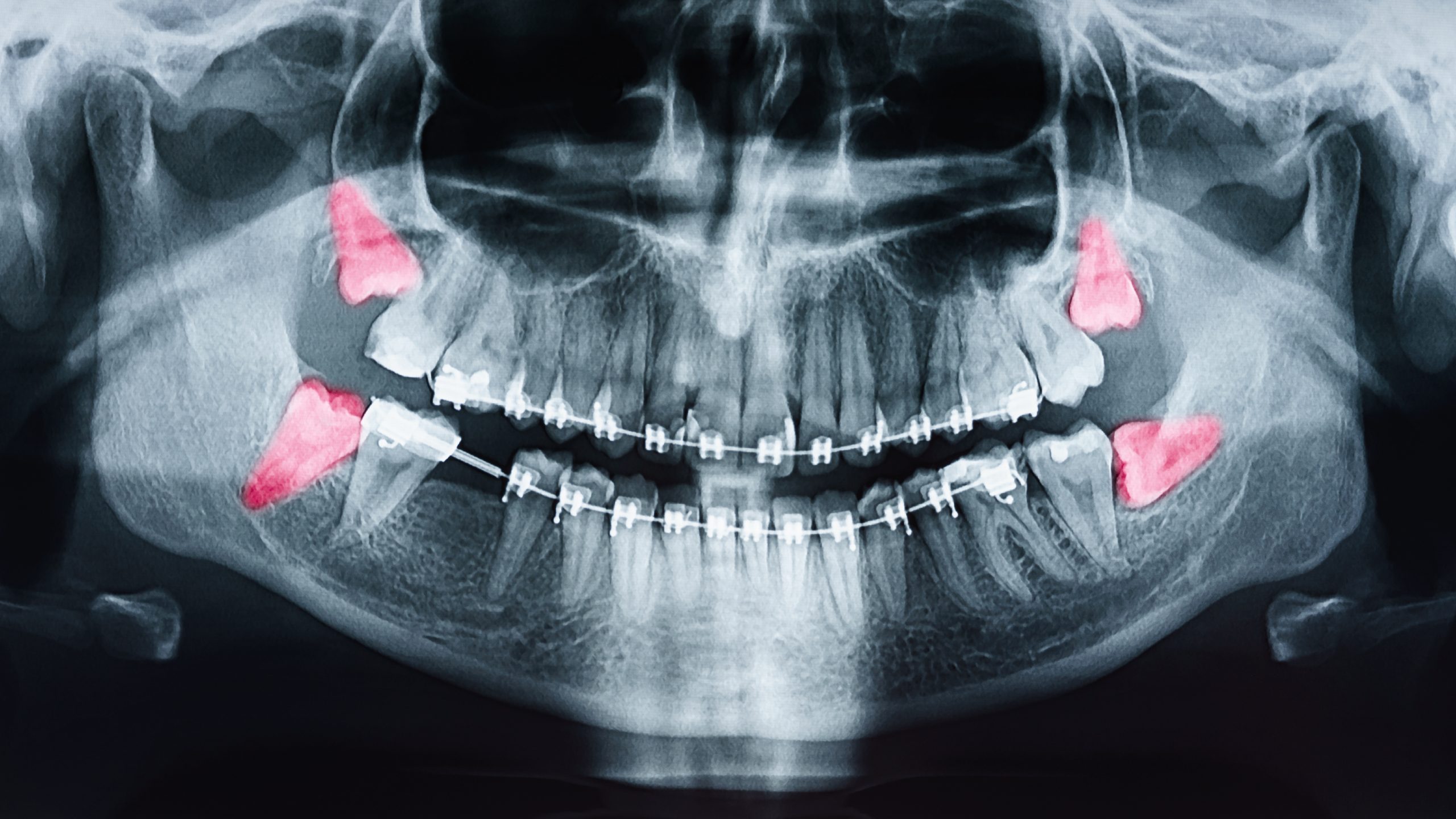 All four wisdom teeth extraction