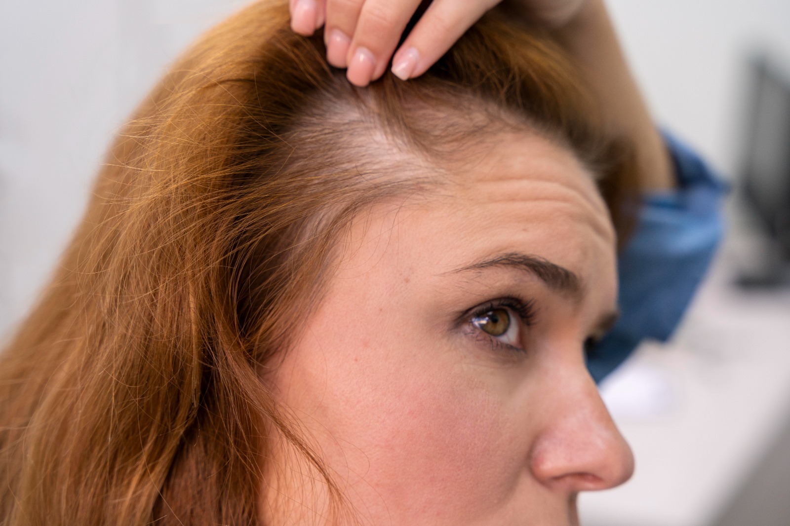 Understanding alopecia areata at Aliva Aesthetics