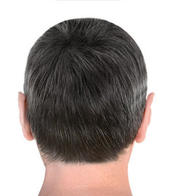 After alopecia areata treatment