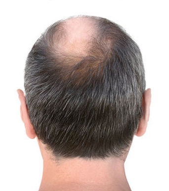 Before alopecia areata