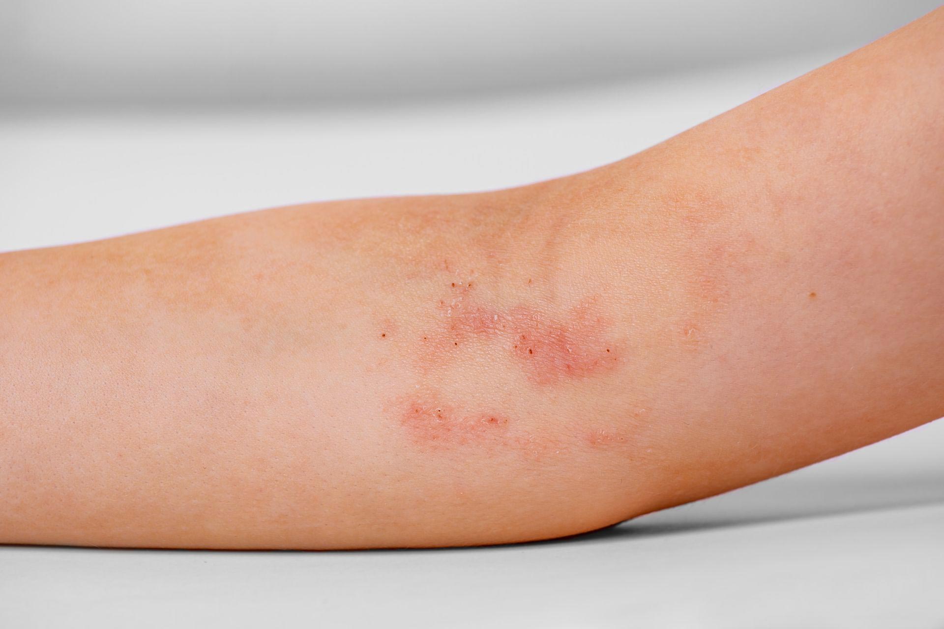 Atopic Dermatitis — Eczema