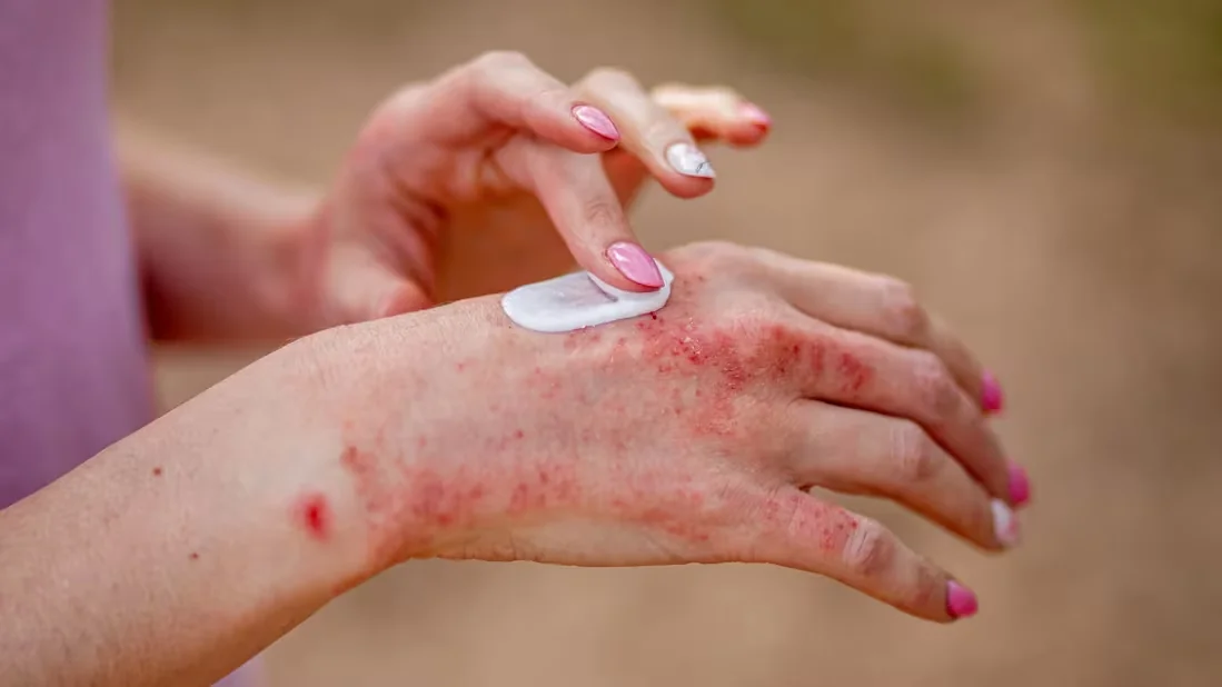 Atopic Flare-Ups — Skin Allergies & Rashes