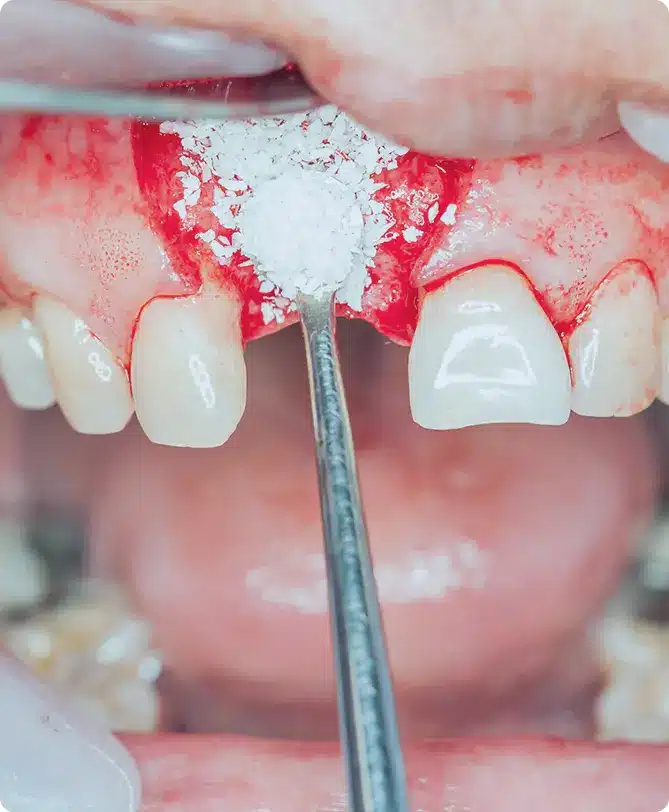 Bone grafting regeneration periodontal