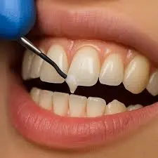 Composite bonding cosmetic dentistry