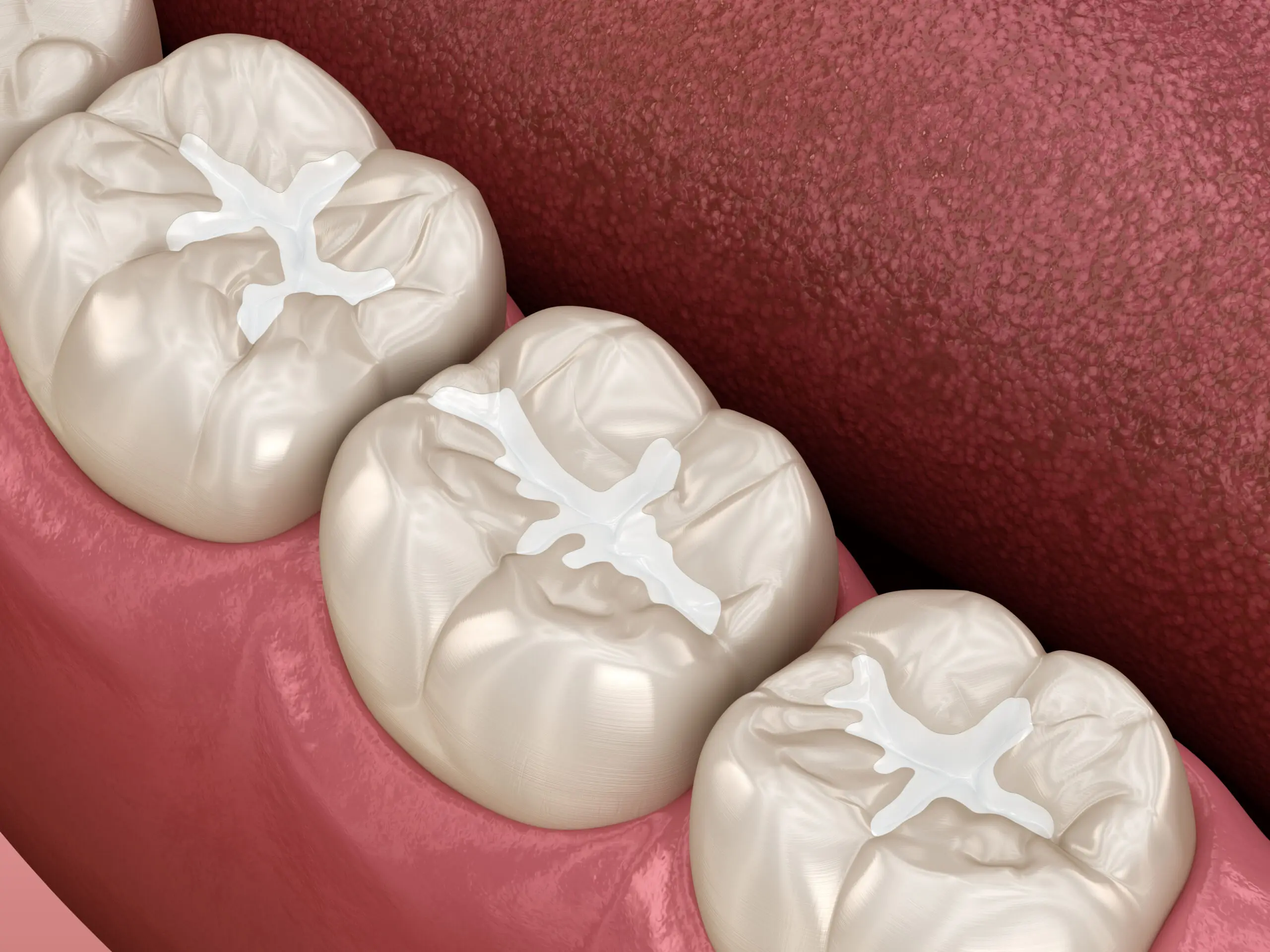 Composite filling tooth colour match