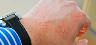 Contact dermatitis scalp reaction