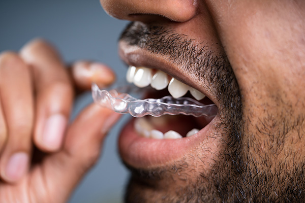 Cosmetic aligners clear dental treatment