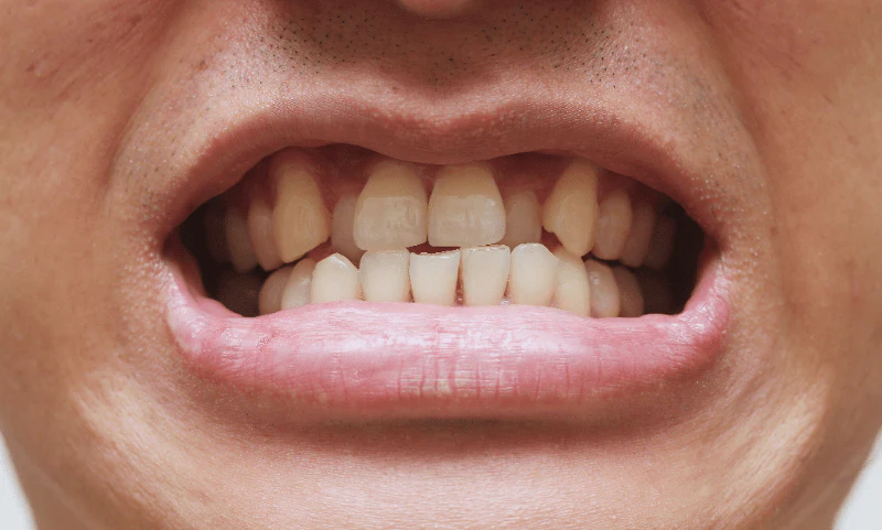 Crossbite braces treatment