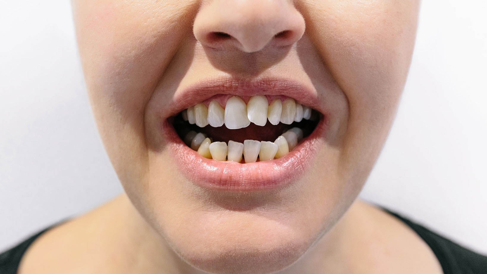 Crowded teeth braces treatment