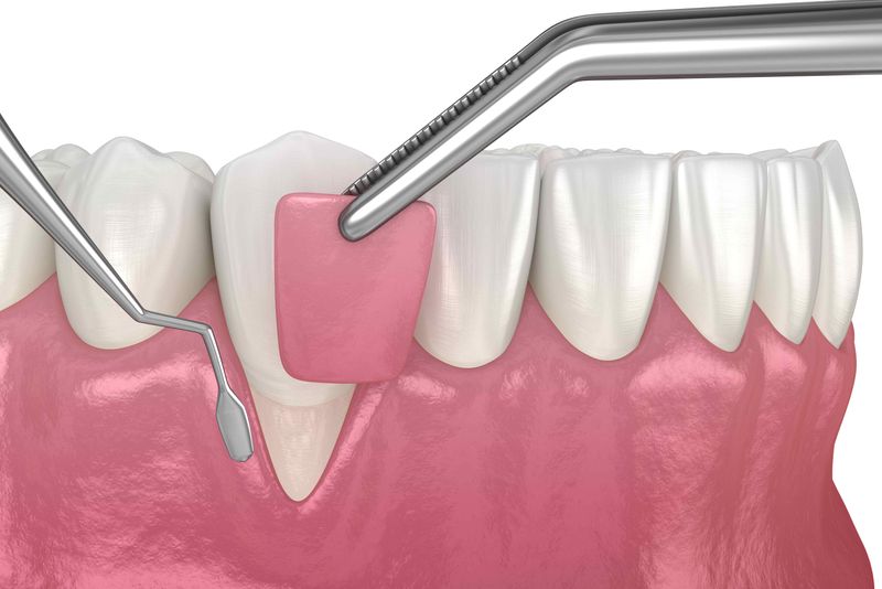Crown lengthening laser dental