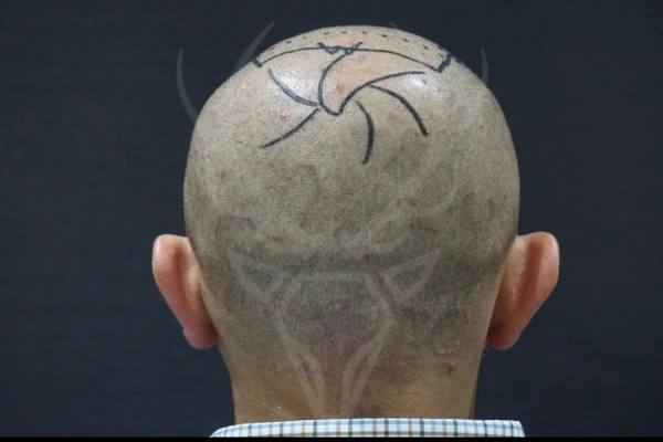 Crown restoration hair transplant grafts