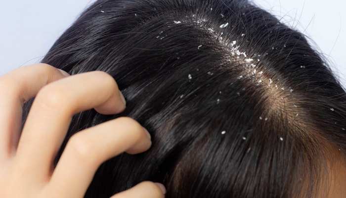 Dandruff Treatment treatment at Aliva Aesthetics, Vijayawada
