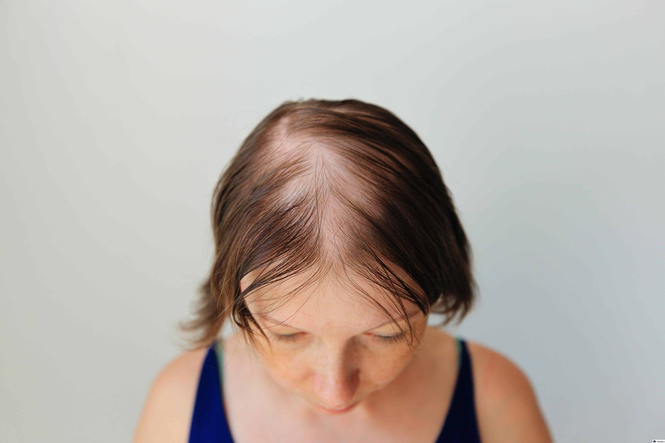 Diffuse crown thinning androgenetic