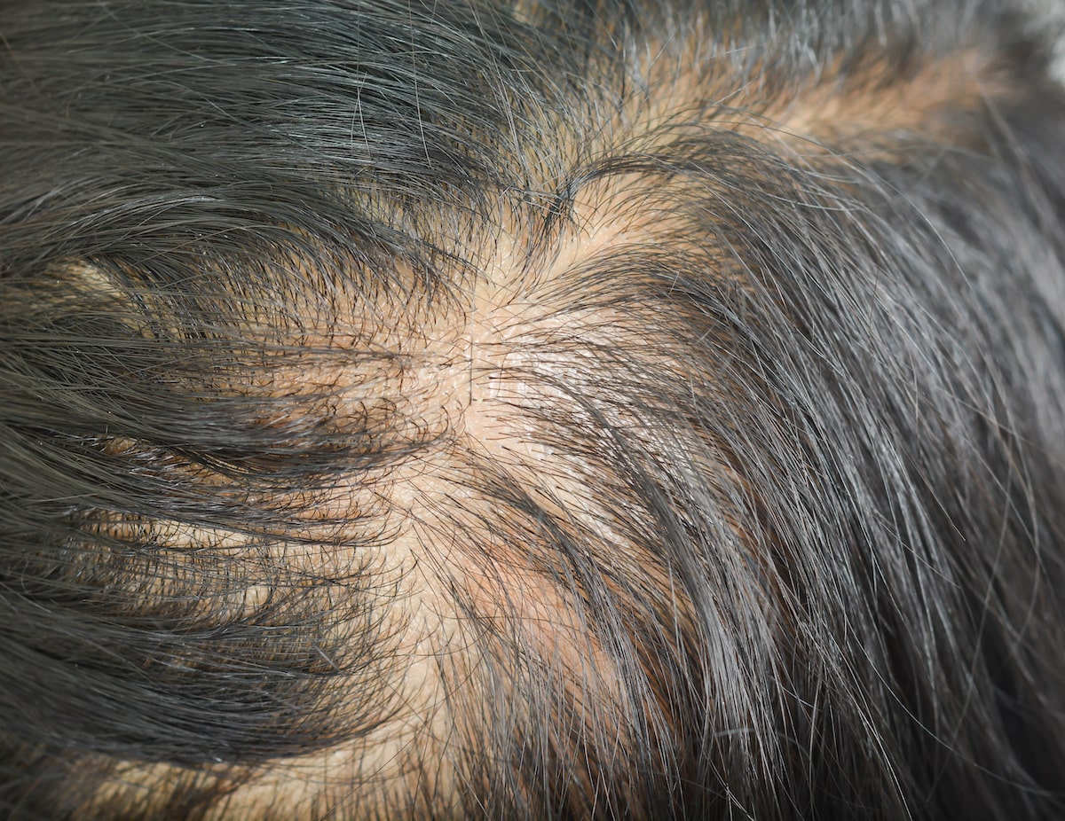 Diffuse thinning all over scalp hair loss