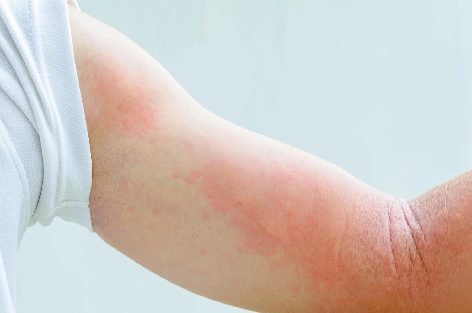 Drug Rashes — Skin Allergies & Rashes