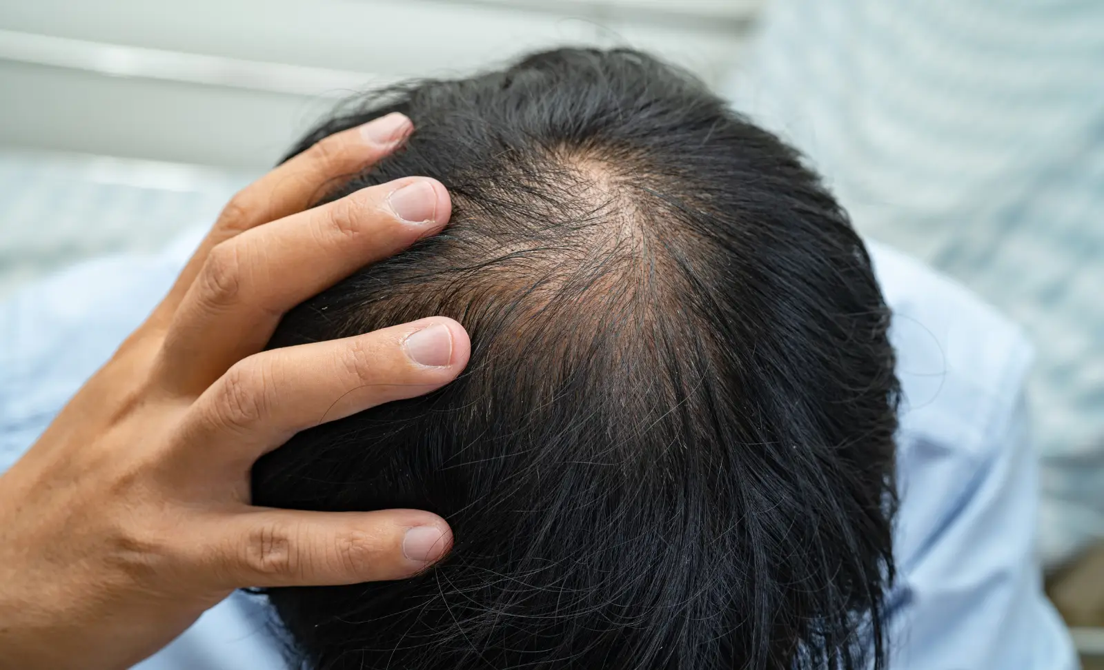 Early hair follicle miniaturisation