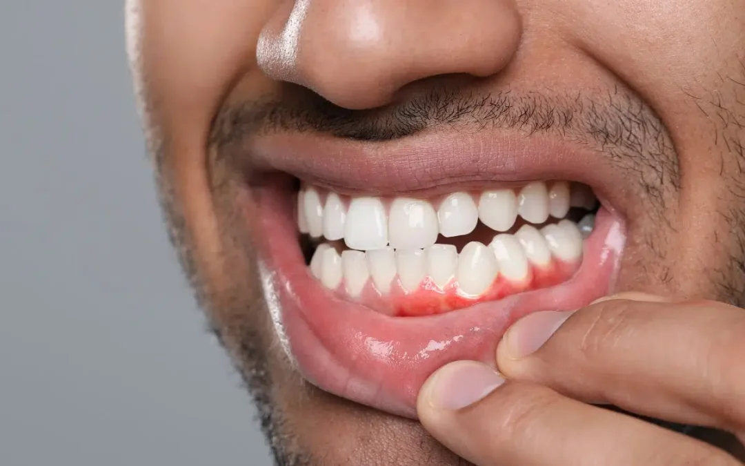 Early periodontitis gum disease