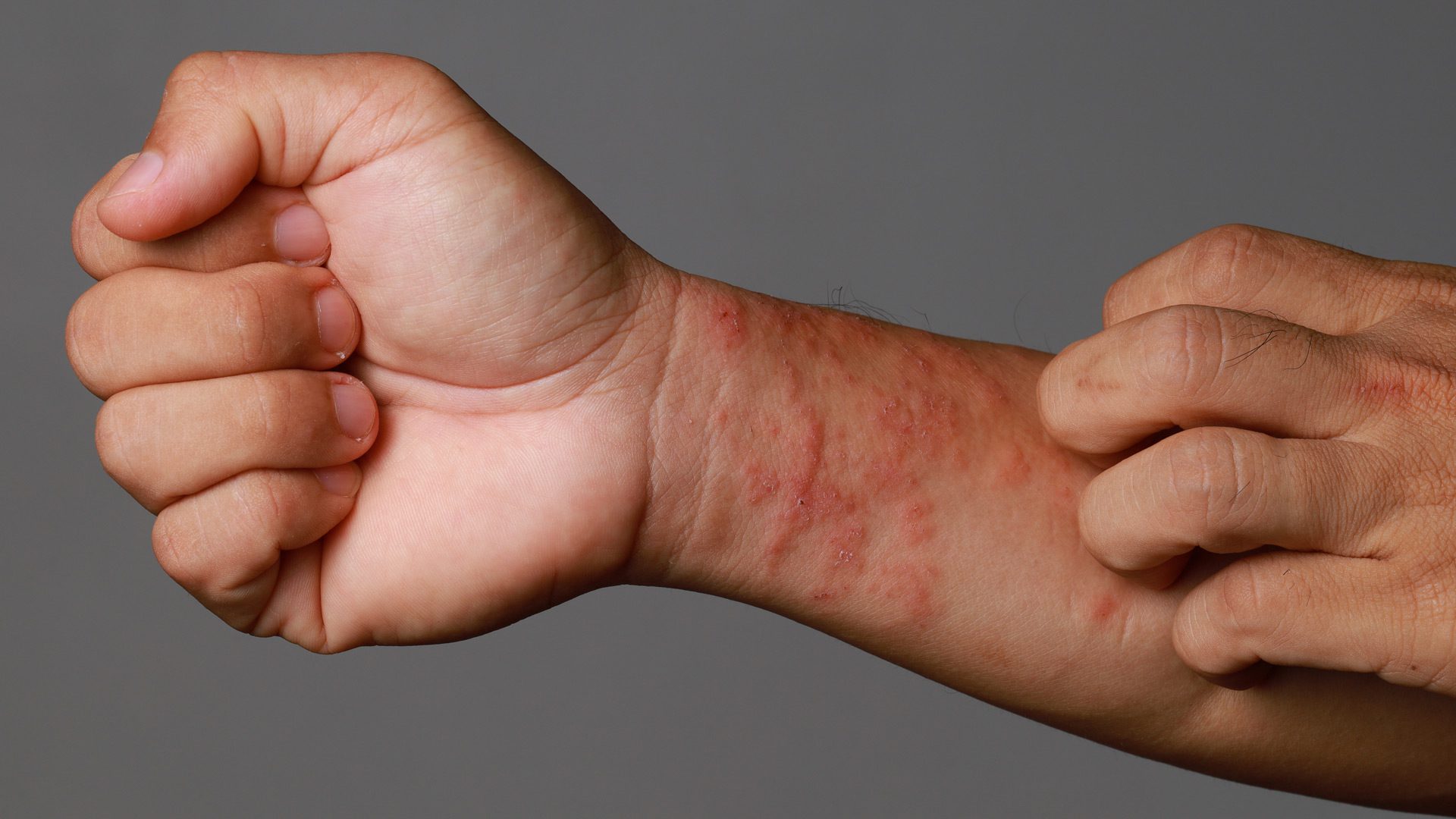 Eczema at Aliva Aesthetics Vijayawada