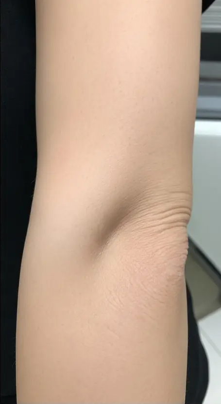 After eczema treatment