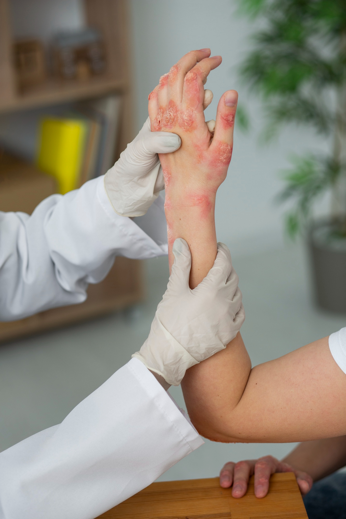 Expert Psoriasis Consultation — Psoriasis at Aliva Aesthetics
