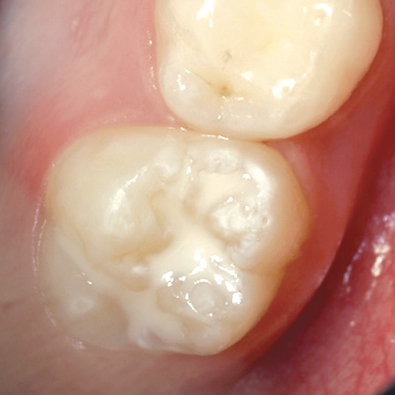 Fissure sealants prevention filling