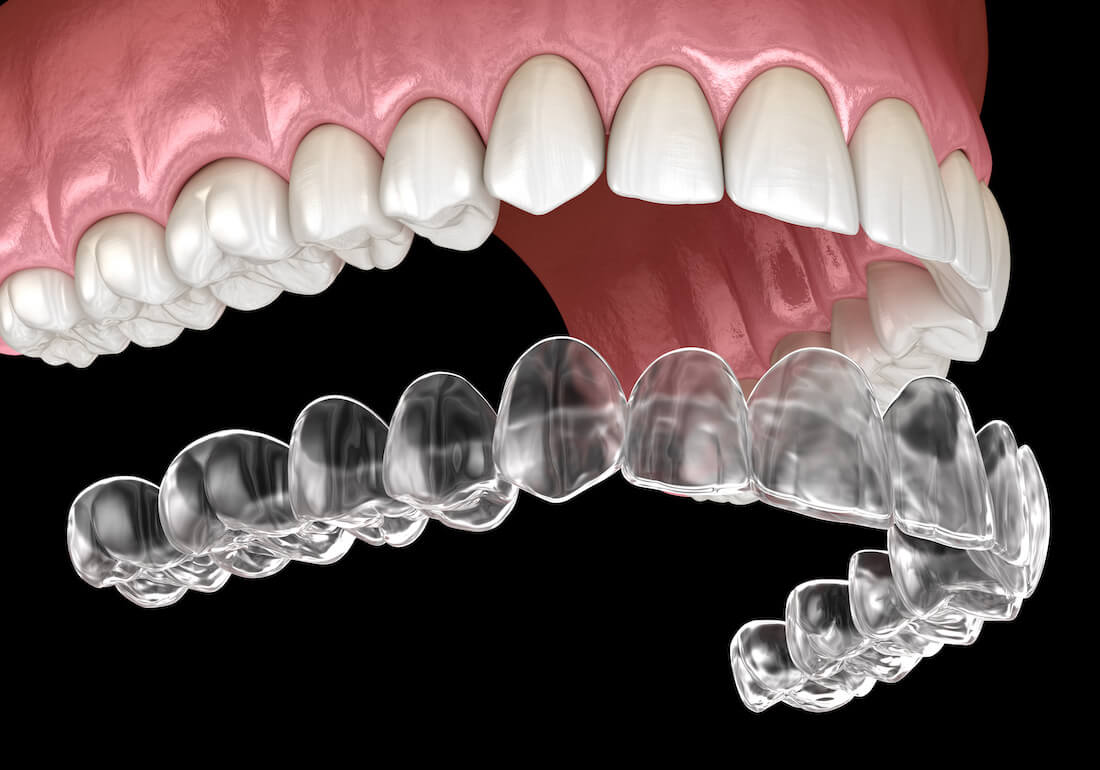 Full alignment clear aligner course