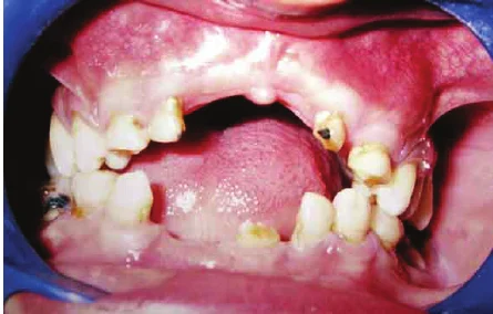 Fully erupted wisdom tooth examination