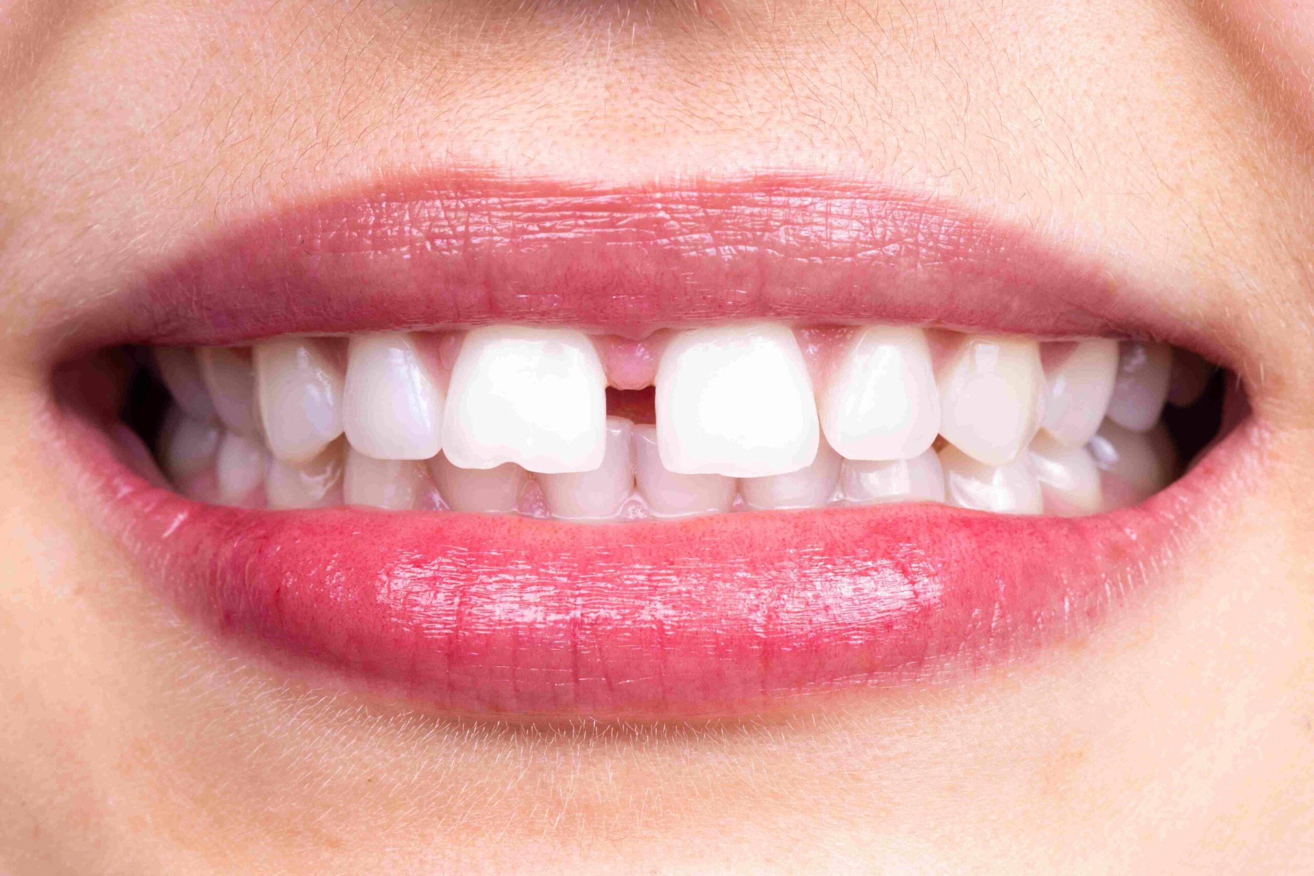 Gaps spacing braces orthodontic