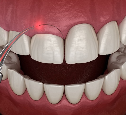 Gum contouring crown lengthening laser