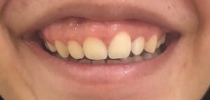 Gummy smile laser correction