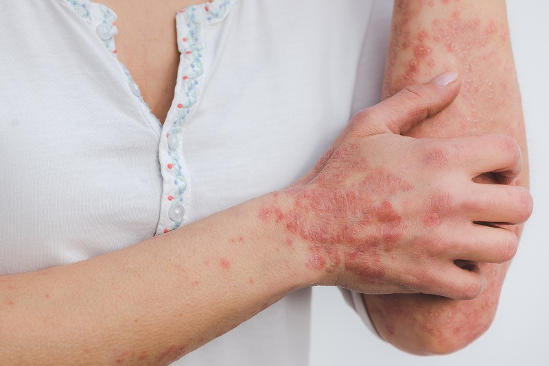 Guttate Psoriasis — Psoriasis