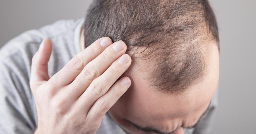 Excessive hair fall reduction treatment