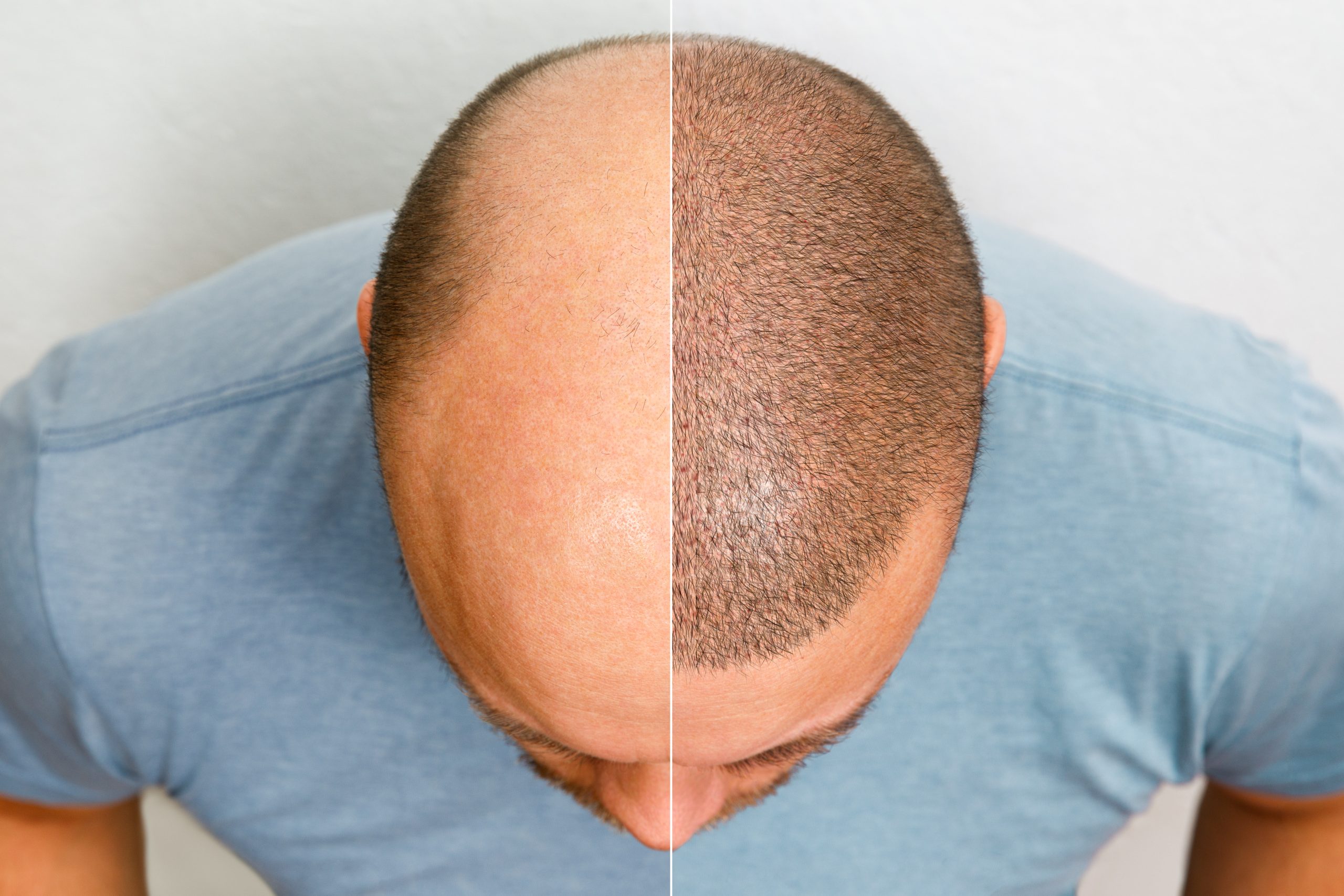 Hair Transplantation treatment at Aliva Aesthetics, Vijayawada