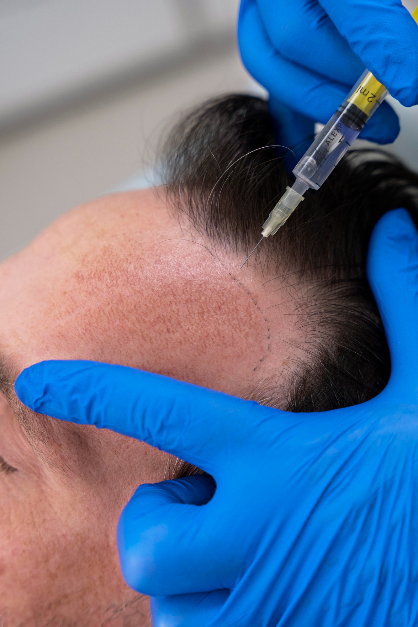 Hair transplantation procedure surgery