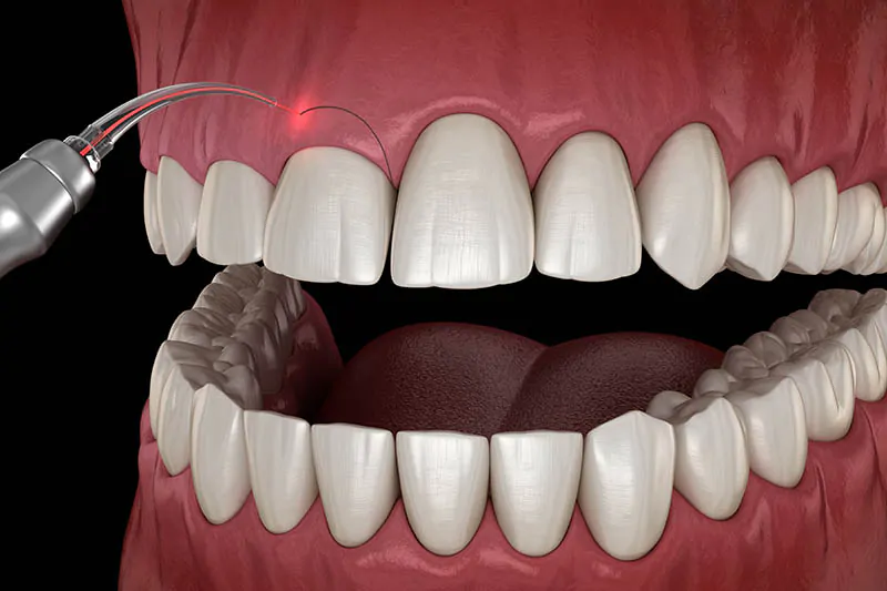 Laser gum contouring aesthetic