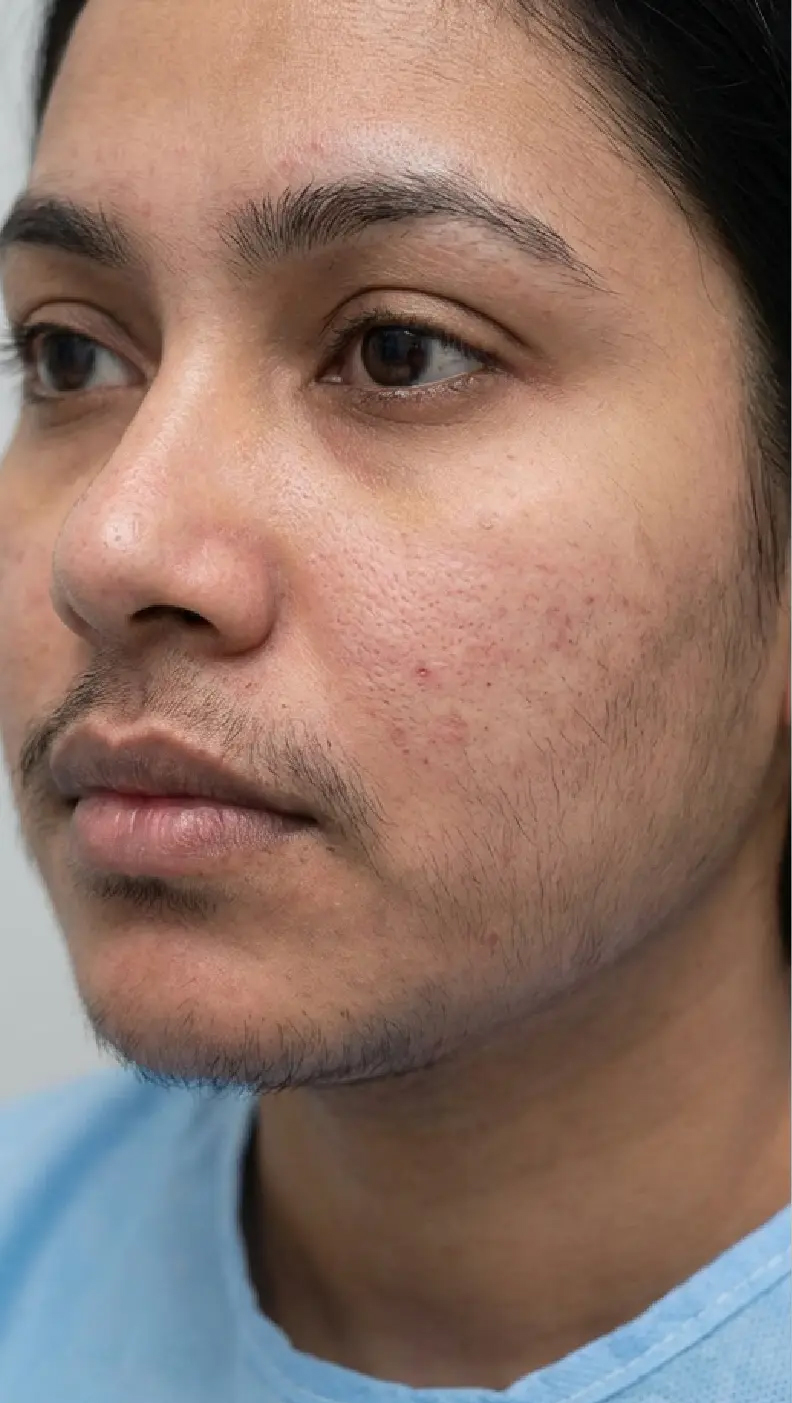 Before laser treatment