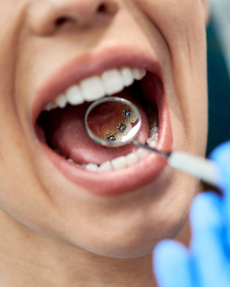 Lingual braces hidden teeth