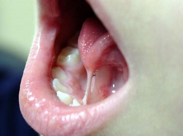 Infant tongue-tie lingual frenectomy