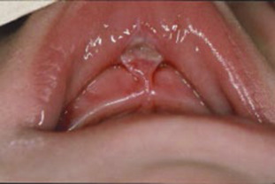 Mandibular labial frenectomy