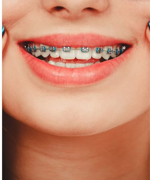 Metal braces orthodontic treatment